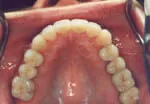 Tooth colored fillings after