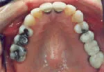 Tooth colored fillings before