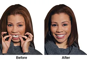 Snap On Smile Before and After