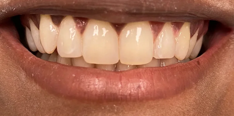 After dental treatment