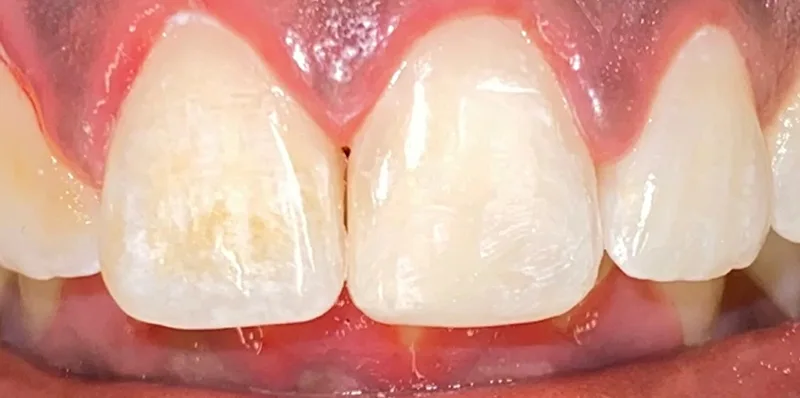 After dental treatment