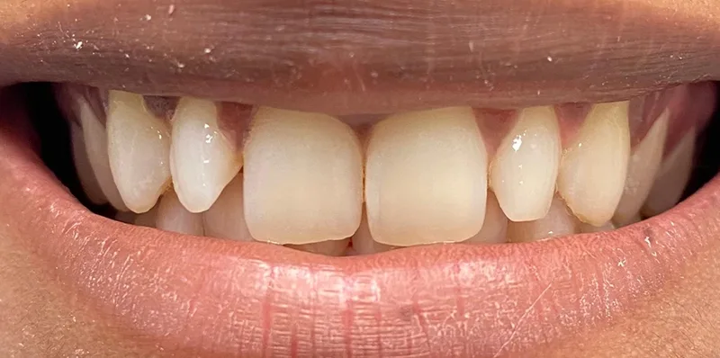 Before dental treatment