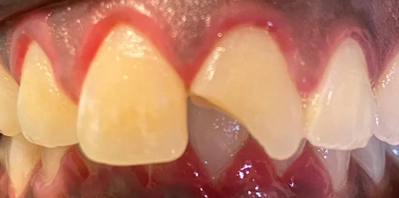 Before dental treatment