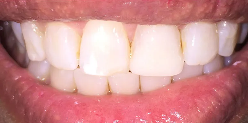 After dental treatment