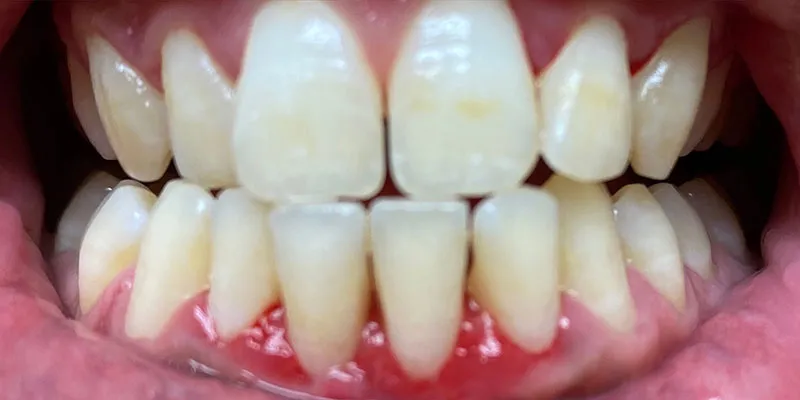After dental treatment