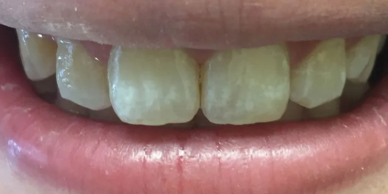 After dental treatment