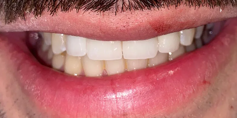 After dental treatment