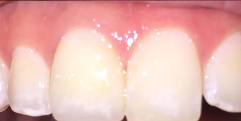 After dental treatment