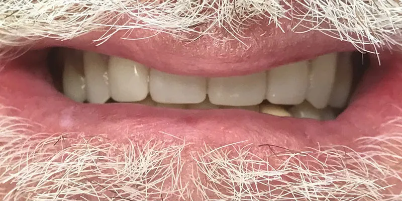 After dental treatment