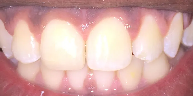 After dental treatment