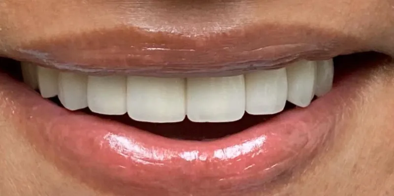 After dental treatment