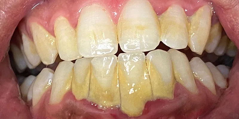 Before dental treatment