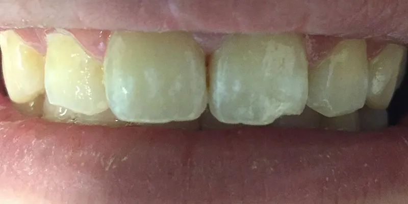 Before dental treatment