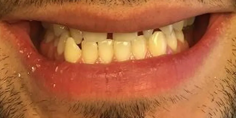 Before dental treatment
