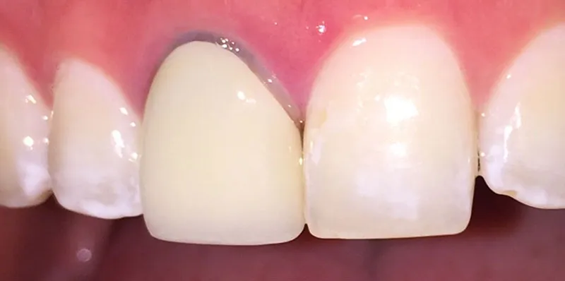 Before dental treatment