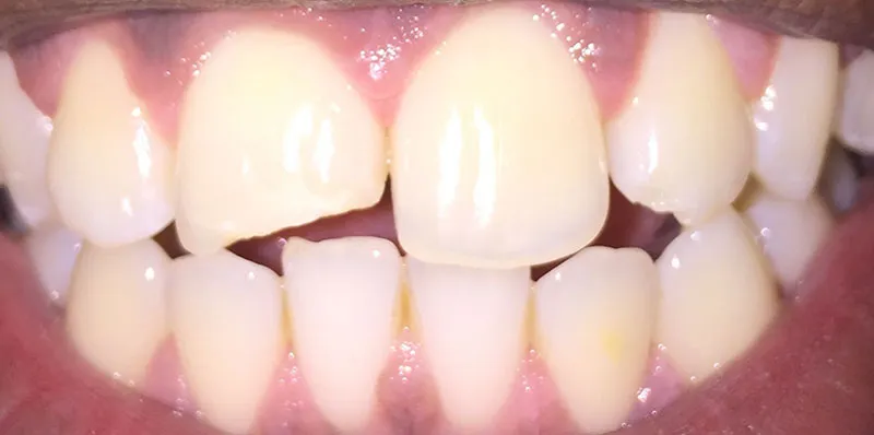 Before dental treatment